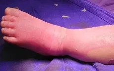 Sai lầm khi xử trí ban đầu cho người bị bỏng