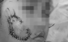 Bé gái bị chó cắn với nhiều vết thương sâu ở vùng mặt