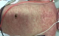 Tăng cường giám sát và phòng chống bệnh sởi