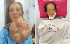 Phẫu thuật thành công khối u gần 5kg xâm lấn vùng hàm mặt bệnh nhân