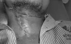 Kịp thời xử trí ca viêm tấy sàn miệng lan tỏa có nguy cơ tử vong cao