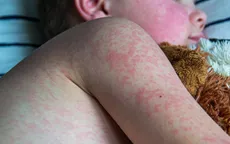 Số ca mắc sởi trên toàn thế giới tăng mạnh