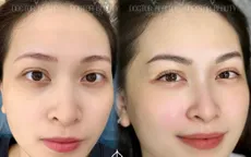 Viện thẩm mỹ Doctor Beauty tặng gói xóa xăm chân mày 8 triệu