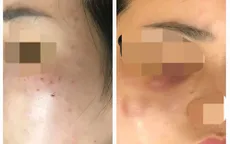 Cơ sở spa tiêm nhầm sữa rửa mặt vào da cho khách