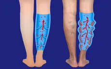 Tái phát sau điều trị suy giãn tĩnh mạch chân bằng laser xung dài
