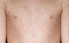 WHO cảnh báo số ca mắc sởi gia tăng trở lại ở châu Âu