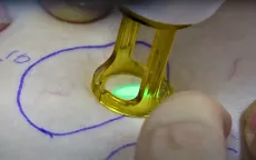 Những bước tiến mới trong việc điều trị suy giãn tĩnh mạch hiện nay