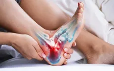 Viêm cân gan chân: Ai có nguy cơ và cách điều trị?