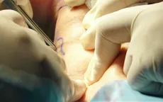 Biến chứng trong điều trị suy giãn tĩnh mạch: Bác sĩ đưa ra khuyến cáo