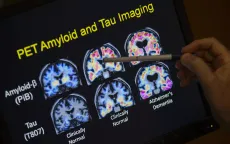 Phương pháp xét nghiệm máu giúp chẩn đoán bệnh Alzheimer nhanh và chính xác hơn