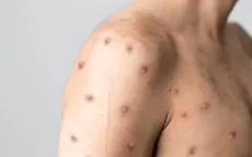 WHO họp khẩn về sự lây lan của bệnh đậu mùa khỉ