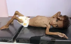 Nạn đói lan rộng ở Yemen, hàng triệu trẻ em có nguy cơ suy dinh dưỡng nghiêm trọng