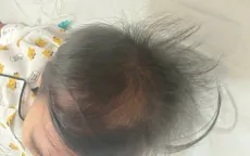 Nghiện ăn tóc, bé 3 tuổi phải nhập viện cấp cứu