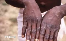 Ban bố tình trạng khẩn cấp về sức khỏe cộng đồng tại Congo