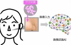 Phát hiện vi khuẩn gây mụn trứng cá nhờ công nghệ AI