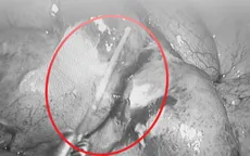 Gắp thành công dị vật tăm tre dài gần 6 cm đâm xuyên thành ruột