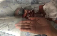 Hy hữu hai trẻ sinh đôi ra đời cách nhau 3 ngày