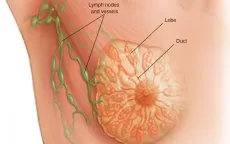 Đột phá về công nghệ nano thắp lên hy vọng điều trị ung thư vú ác tính
