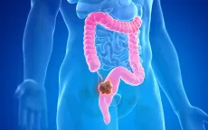 Phát hiện yếu tố làm tăng nguy cơ ung thư đại tràng ở người trẻ