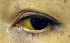 Viêm gan B: Chủ động tiêm phòng, phát hiện sớm để ngăn biến chứng nguy hiểm