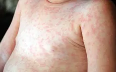 TP Hồ Chí Minh tiến tới công bố hết dịch sởi trên toàn địa bàn
