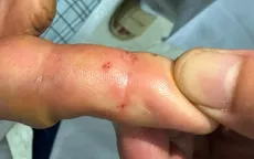 Bị rắn độc cắn khi đang cho gà ăn, người phụ nữ may mắn được cứu sống