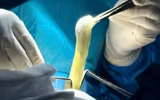 Vỡ túi ngực là gì?