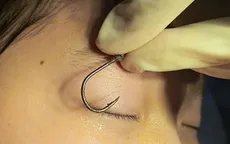 Móc câu đâm vào mắt trẻ 7 tuổi khi đi chơi - Cảnh báo tai nạn mùa Hè