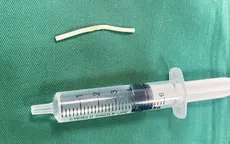 Nhập viện vì que tránh thai "đi lạc" vào cơ tay
