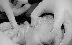 Hy hữu: Mẹ tròn con vuông dù bé bị 4 vòng rau quấn cổ