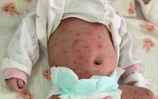 Bé sơ sinh 15 ngày tuổi nguy kịch vì thủy đậu biến chứng