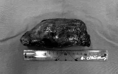 Cắt bỏ u mô mềm ác tính dễ tái phát ở đùi bệnh nhân 76 tuổi