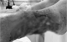 Lóc da cẳng chân do tai nạn - Bệnh nhân đái tháo đường đối mặt nguy cơ hoại tử