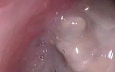 Hiếm gặp: Gắp sỏi 3cm trong hốc mũi bệnh nhân bằng nội soi