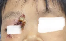 Cẩn trọng tai nạn mắt ở trẻ ngày hè