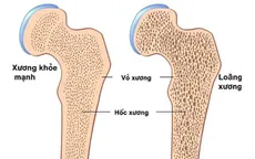 Phòng ngừa bệnh loãng xương như thế nào?