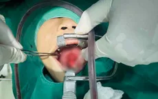 Bé trai 9 tuổi bị que nứa đâm rách vùng miệng - họng khi chơi đùa