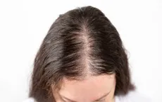 Phát hiện tình cờ loại đường giúp đảo ngược rụng tóc di truyền mà không cần thuốc