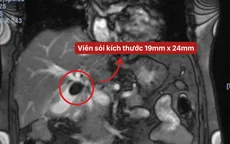 Viêm hoại tử túi mật vì viên sỏi 2.4cm
