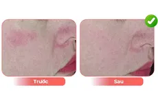 Giải pháp cho da tiền lão hóa độ tuổi từ 40 đến 50 tuổi