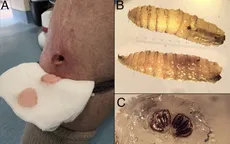 Mỹ ghi nhận ca giòi ăn thịt ở người đầu tiên trong nhiều thập kỷ