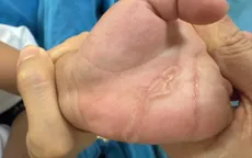 Bé trai 4 tuổi nhiễm sán máng từ vết xước nhỏ ở kẽ ngón tay