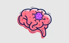 Phẫu thuật thành công khối u sụn xương sọ có kích thước khổng lồ