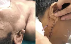 Cụ ông nhập viện vì khối u góc hàm tái phát sau 10 năm