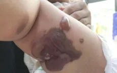 Đắp tỏi chữa rết cắn: Bài thuốc dân gian suýt hại bé 8 tháng tuổi