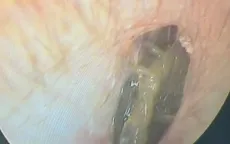 Hy hữu: Gắp thành công con rết còn sống trong ống tai người đàn ông