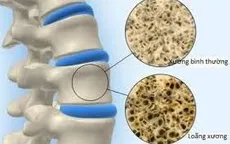 Loãng xương - căn bệnh âm thầm nhưng để lại hậu quả nặng nề
