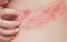 Hà Nội: Gia tăng bệnh da liễu ở trẻ em