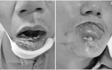 Tự điều trị mụn, nam bệnh nhân nhập viện vì nhiễm vi khuẩn đa kháng thuốc