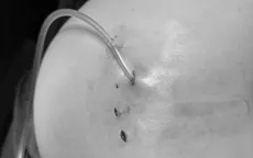 Tiêm filler: Làm đẹp nhanh hay cái giá sức khỏe phải trả?